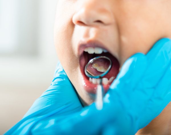 Dental kid health examination. Doctor examines oral cavity of little child uses mouth mirror to checking teeth cavity, Asian dentist making examination procedure for smiling cute little girl